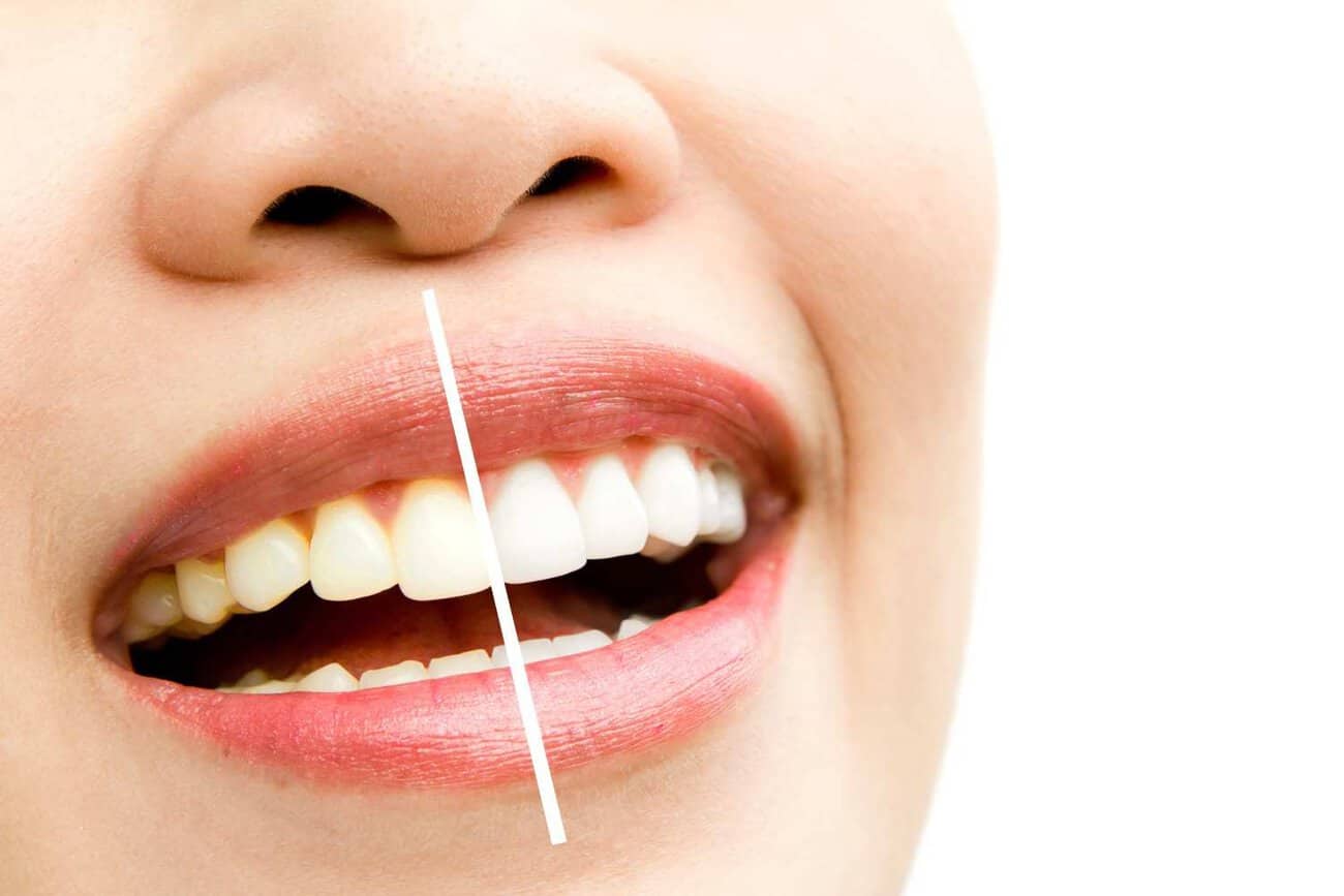 Why Do Some People Experience Sensitivity After Laser Teeth Whitening Coventry